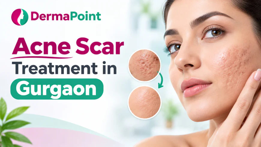Acne Scar Removal Treatment Gurgaon: How to Choose the Right Dermatologist and Clinic