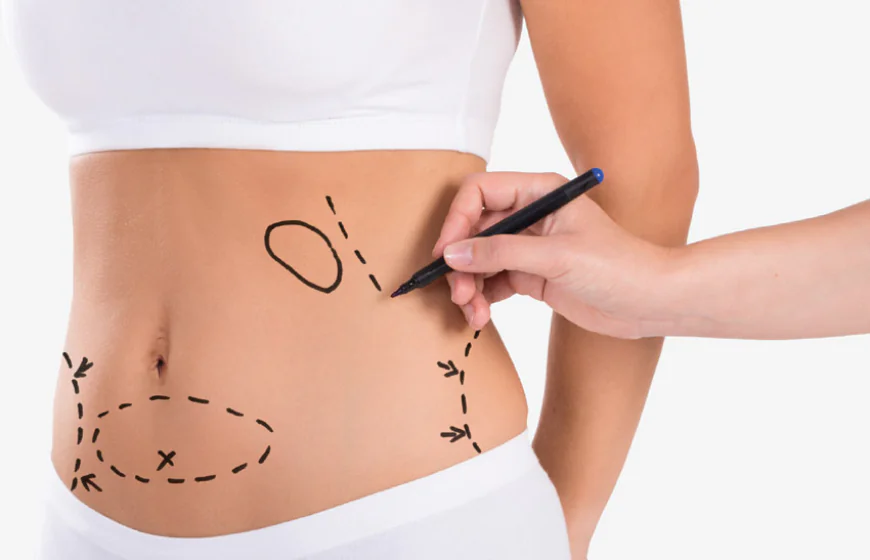 What Are the Different Types of Tummy Tuck?