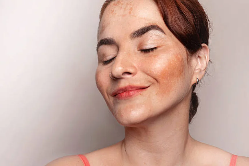 What Can Melasma Treatment Do for Your Complexion?