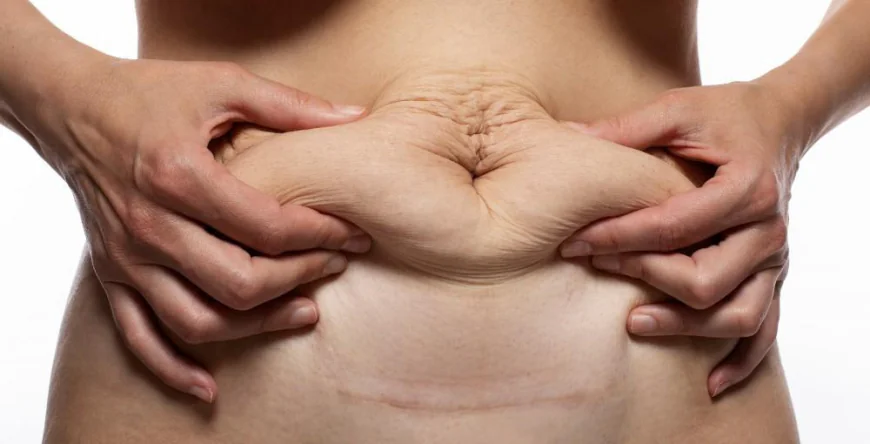 What Areas Does a Tummy Tuck Treat?