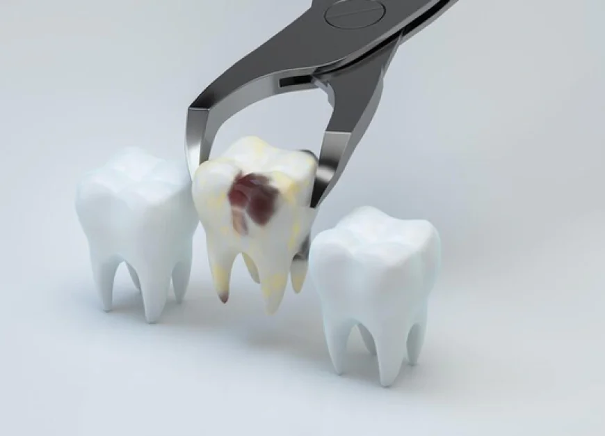 The Essential Guide to Tooth Extractions: Preparing for Your Dental Procedure
