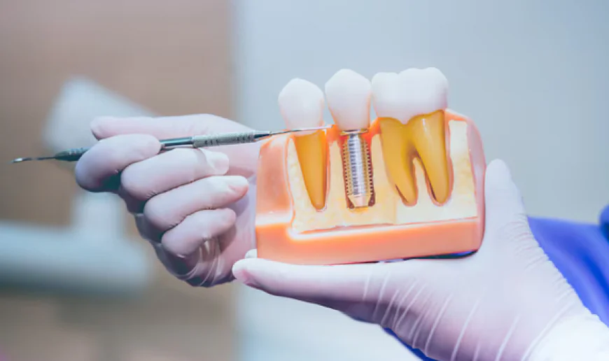 The Rise of Dental Implants as the Preferred Tooth Replacement Option