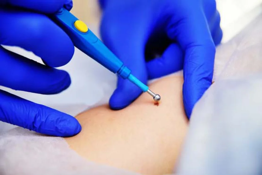 What Results Can You Expect From Mole Removal