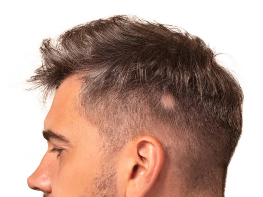 Alopecia Areata Treatment in Dubai for Small Scalp Patches