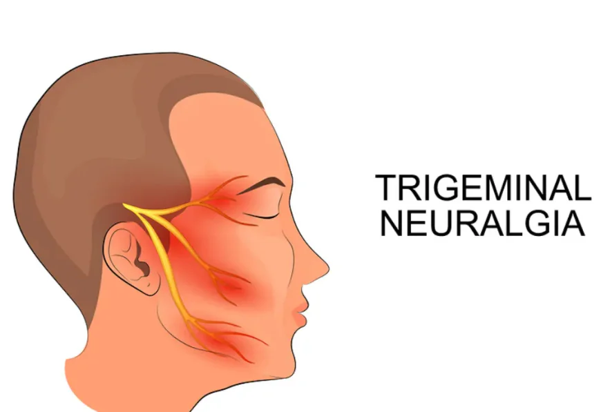 Trigeminal Neuralgia Treatment Al Ain: Diagnosis and Care
