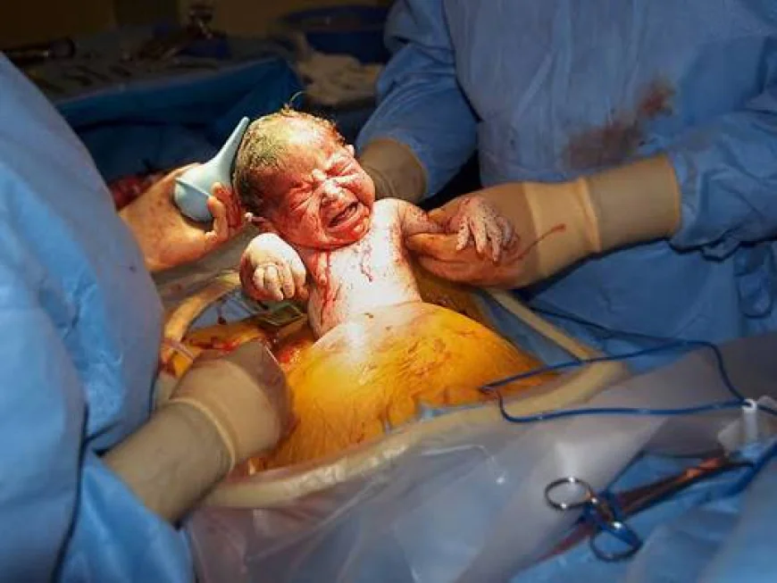 Cesarean Section Surgery: A Complete Patient Information Guide