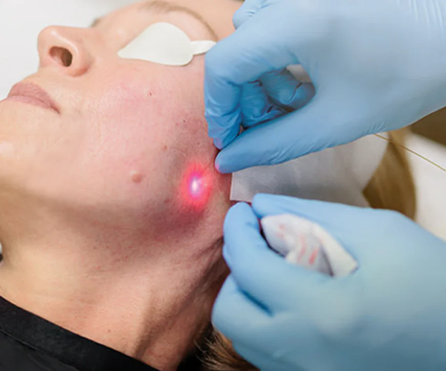 Can Endolift Treatment Improve Jawline Definition Naturally?