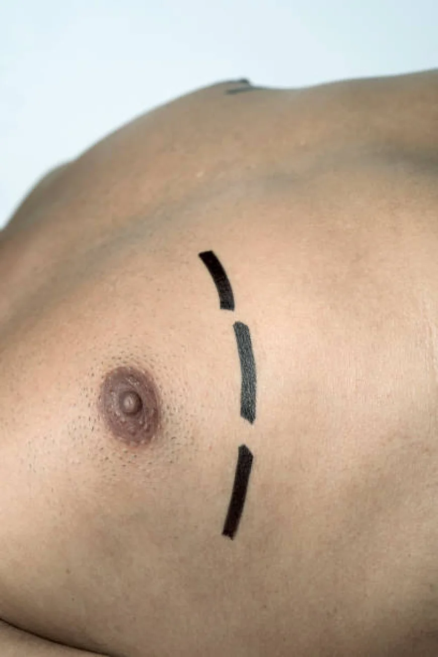 Experience Personalized Chest Contouring with Gynecomastia Surgery