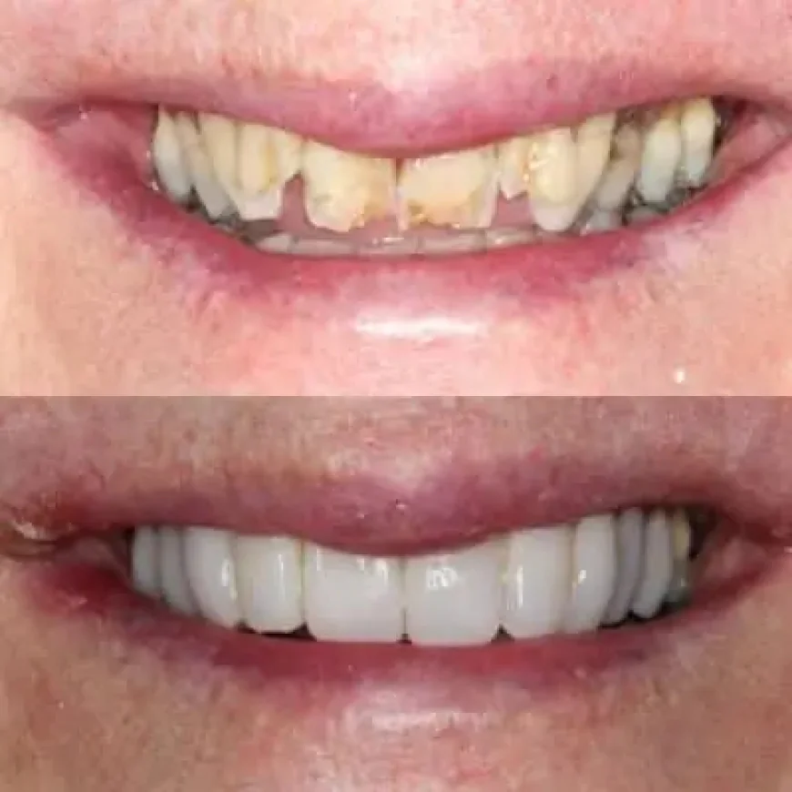 Can Composite Veneers Sydney Create a More Confident Smile? | Timeless Smiles Dental