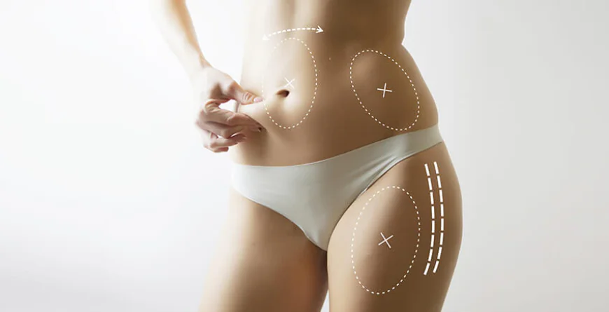 Liposuction in Riyadh: Discover Advanced Body Contouring Options