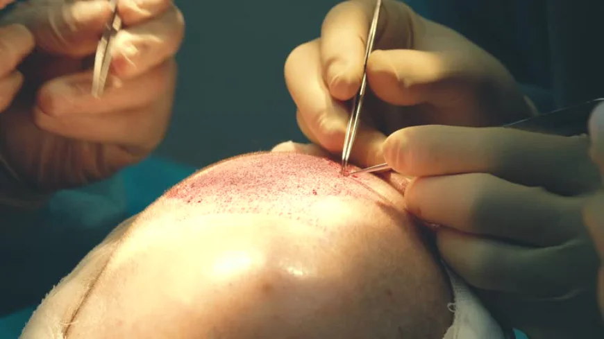 Can FUE Hair Transplant in Dubai Improve Crown Hair Flow?