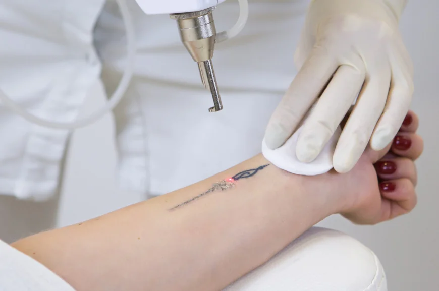 Is Tattoo Removal a Good Option for Reducing Old Tattoos?