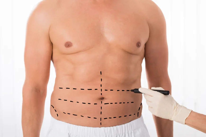 Is a Tummy Tuck Used for Abdominal Skin Laxity?