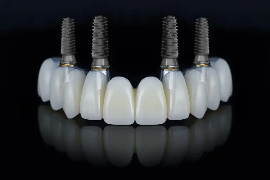 Those Considering All on 4 Brisbane Can Start with Hashtag Dentist