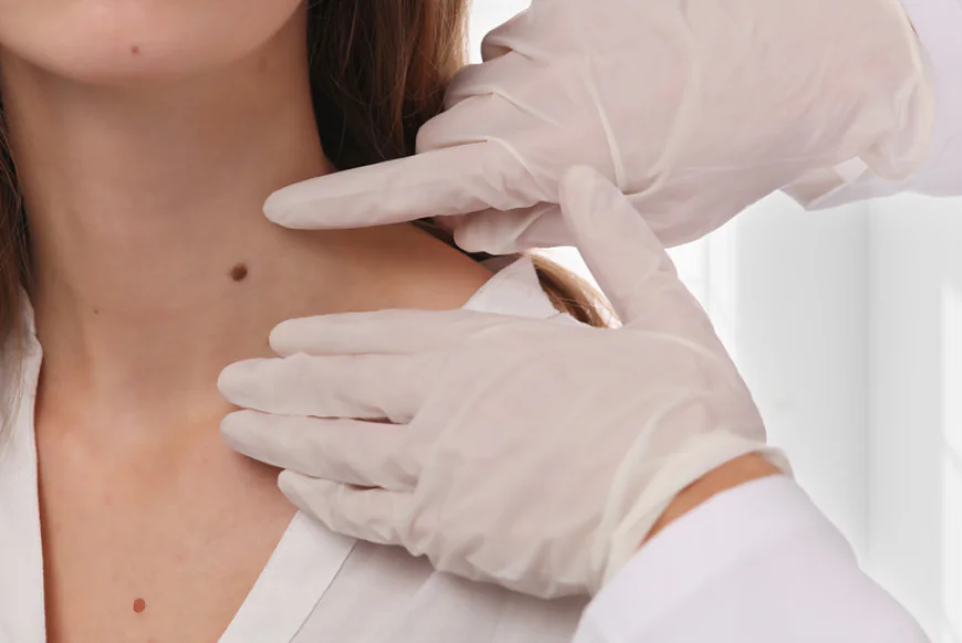 Why Consider Skin Tag Removal?