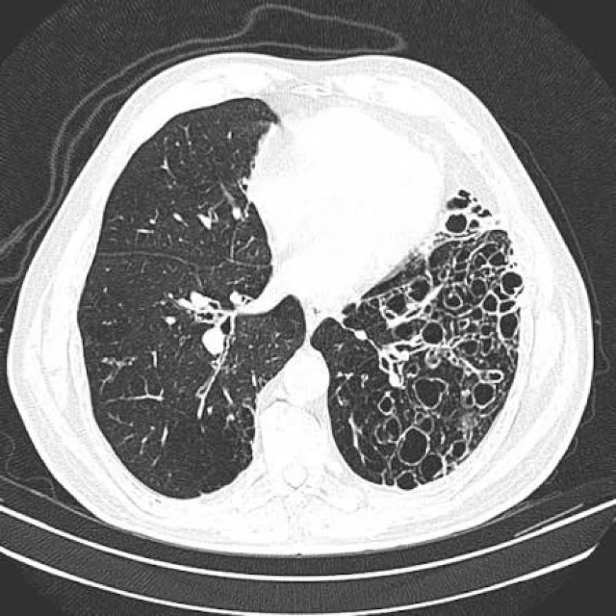 Primary Ciliary Dyskinesia Market Size, Trends, and Strategic Outlook 2026-2033