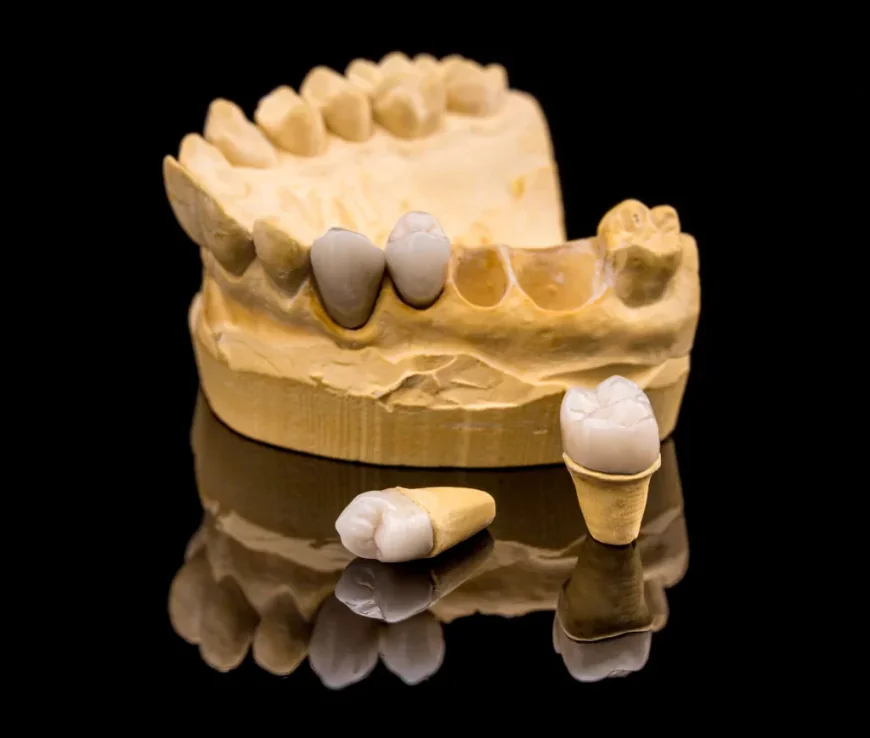 Zirconia Crown Dubai & Abu Dhabi for Improved Tooth Function | Glamorous Clinic Dubai