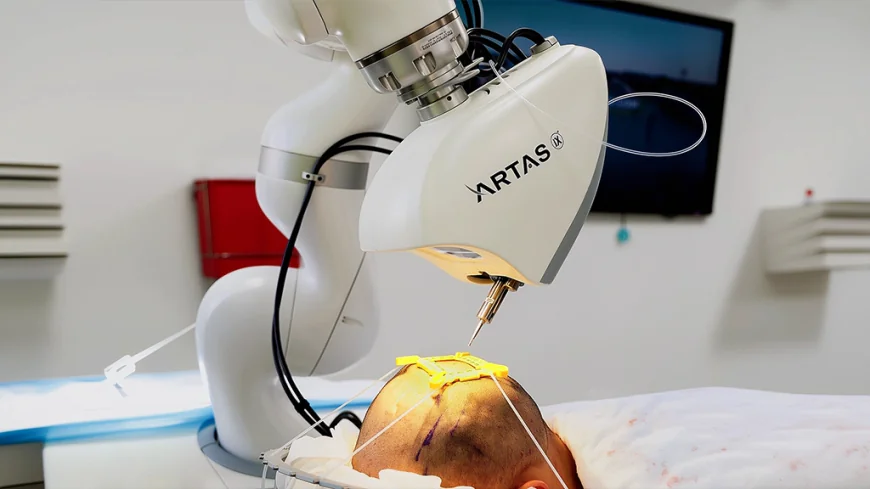 How Does Robotic Hair Transplant Restore Hair?