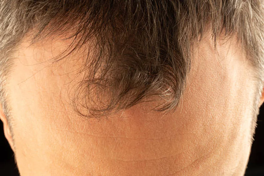 Natural Hairline Treatment in Dubai for Natural Graft Angles