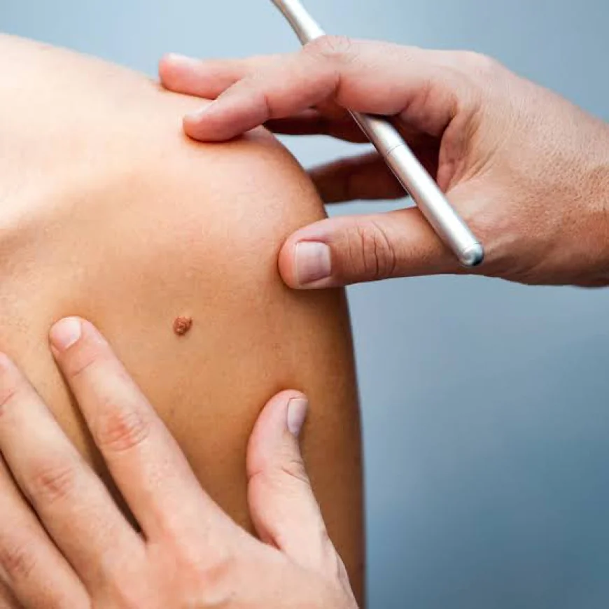 How Does Skin Tag Removal Help Improve Skin Appearance?
