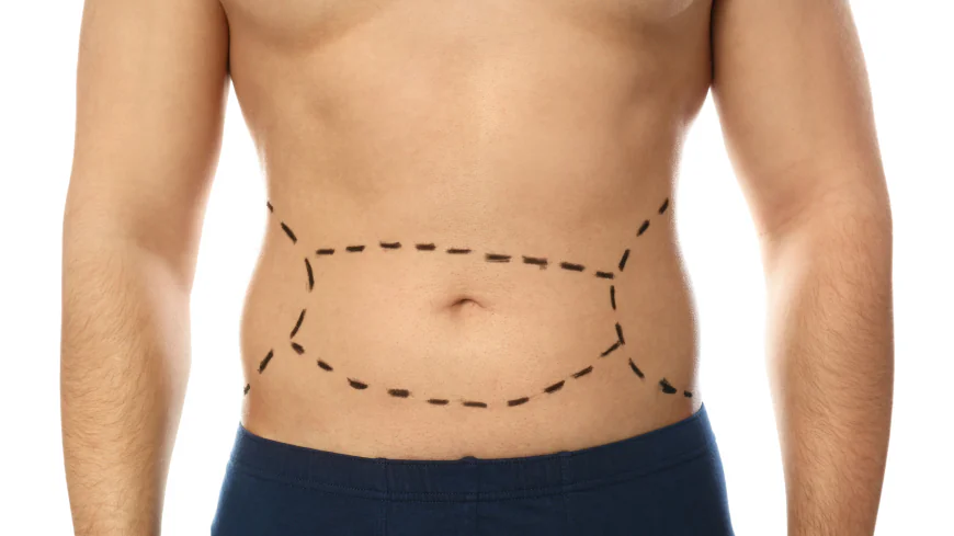 How Do You Prepare for Mini gastric bypass Surgery?