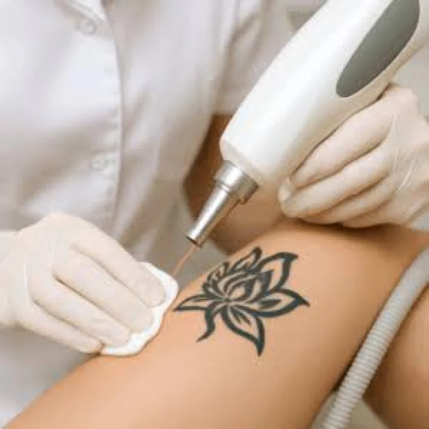 What factors affect Laser tattoo removal results?