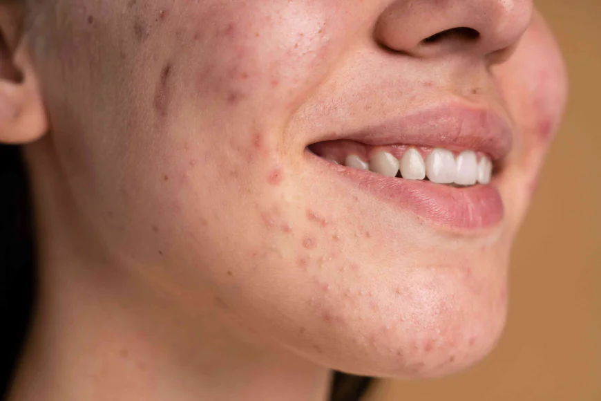 Why Does Acne Keep Coming Back Even After Treatment?