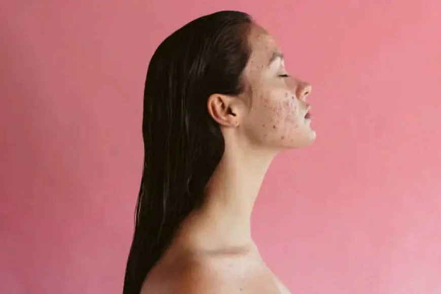 What Can Acne Treatment Do for Recurring Acne?
