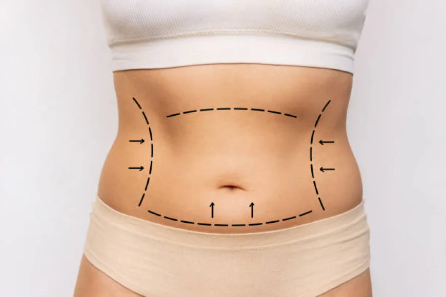 Who Is an Ideal Candidate for Mini Tummy Tuck ?