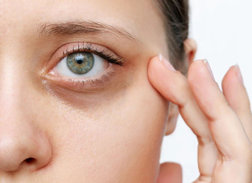 How Can Dark Circles Treatment Refresh Your Eyes?