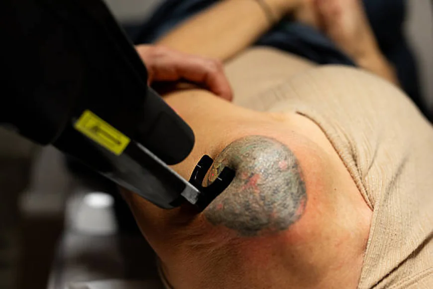 Can Laser Tattoo Removal target stubborn blue tattoo ink