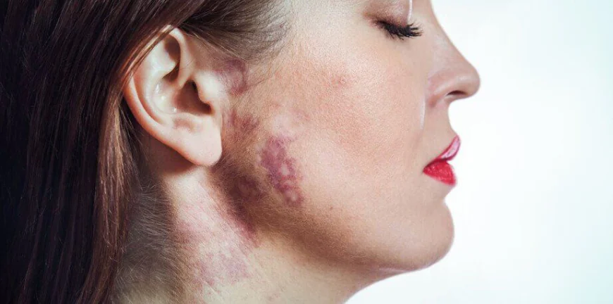What Are the Benefits of Birthmark Removal?