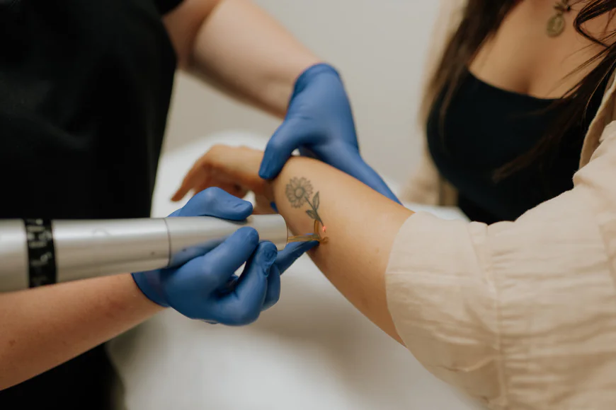 Is Laser Tattoo Removal Worth Considering for You?