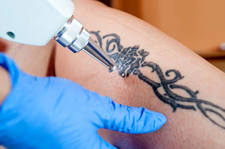 Is Laser Tattoo Removal Effective for Old Tattoos?