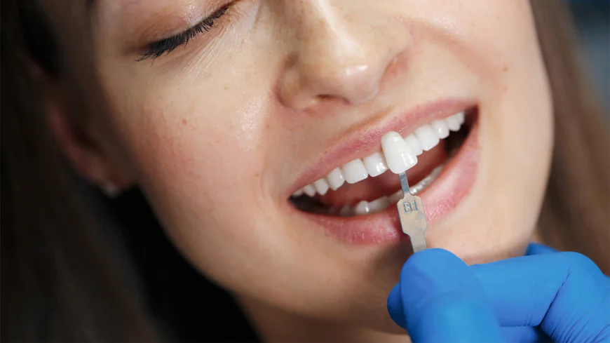 What Determines Veneers Cost