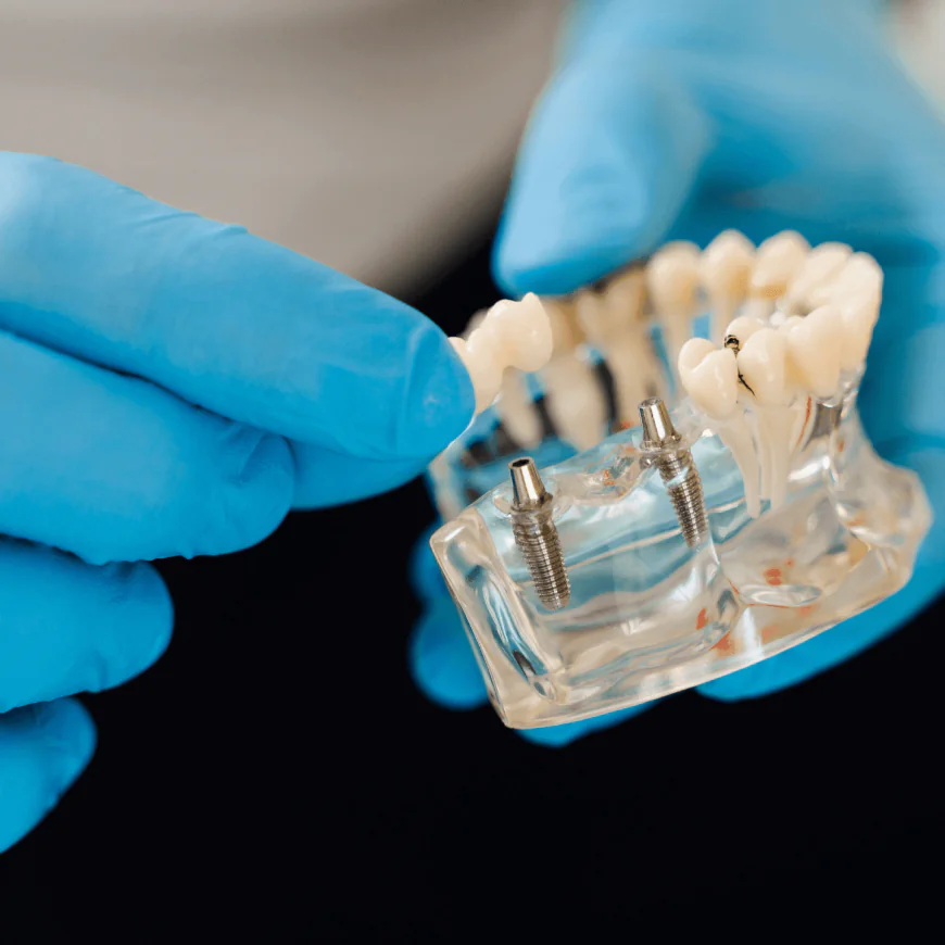 What to Expect at Every Stage of Getting Dental Implants in Temecula
