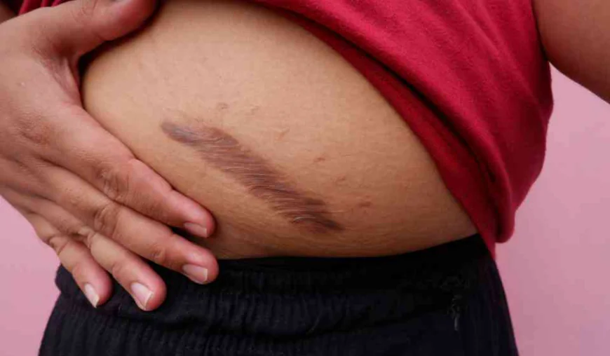 Is Keloid Treatment a Permanent Solution