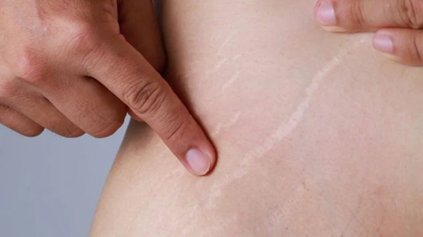 Can Stretch Marks Removal Help Visible Body Lines In Adults?