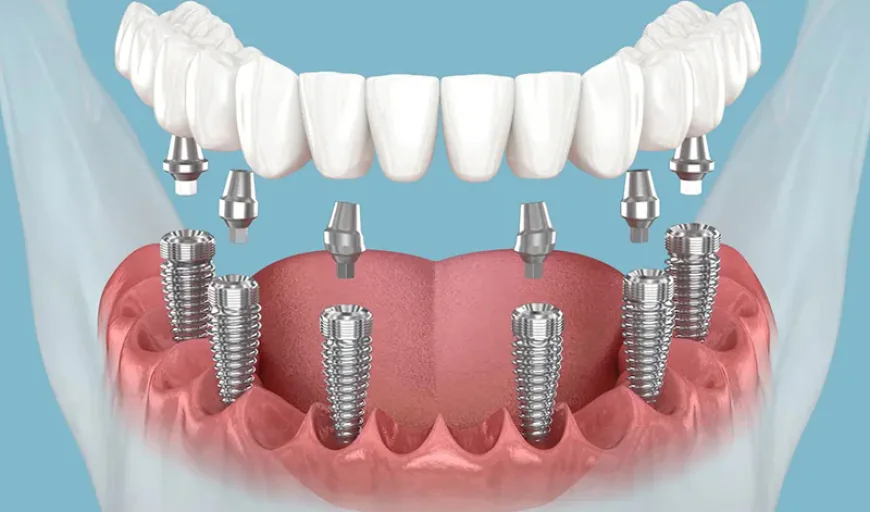 Investing in a Healthier Smile with Dental Implants in West Point, MS