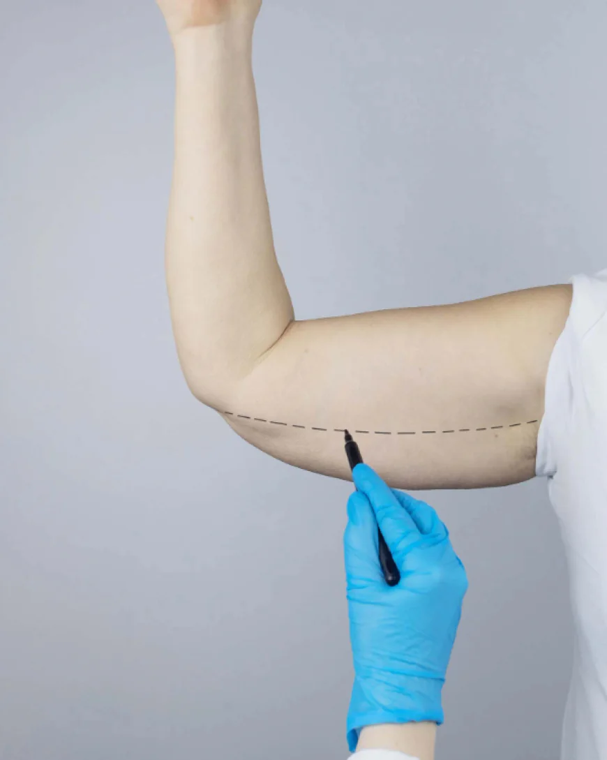 How Arm Lift Surgery Works