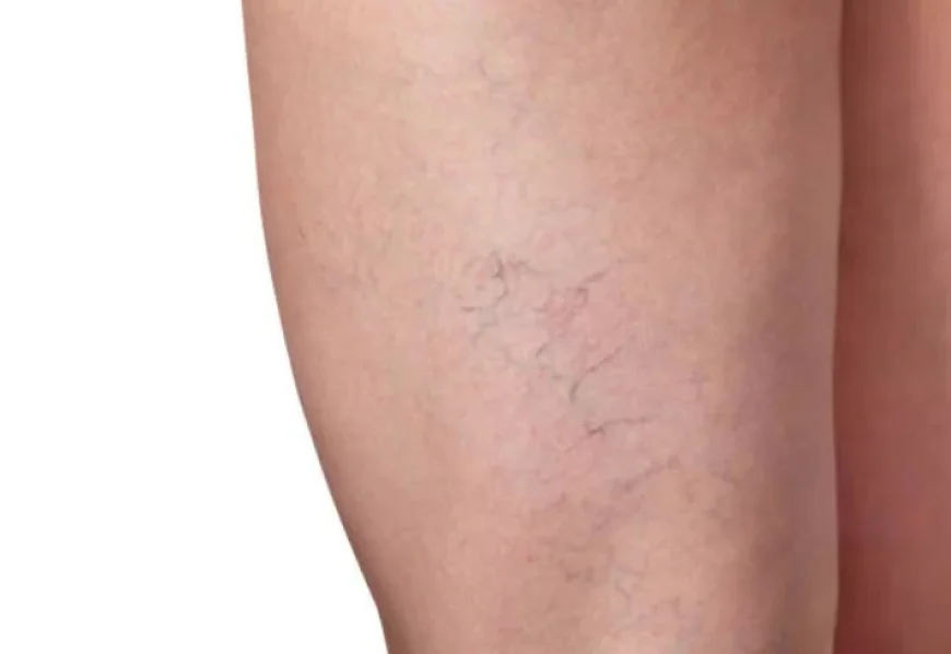 Spider Veins Treatment In Dubai: Advanced Care for a More Even-Looking Leg Appearance