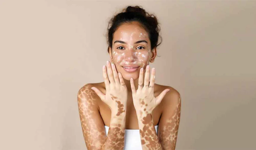 How Do You Prepare for Vitiligo Treatment