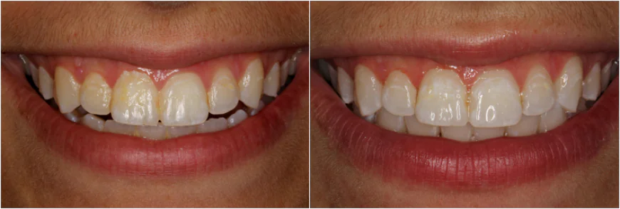 How Tooth-Colored Cavity Fillings Improve Smile Appearance