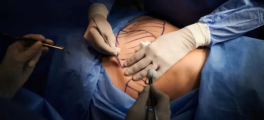 Can Liposuction Help Refine Stubborn Areas?