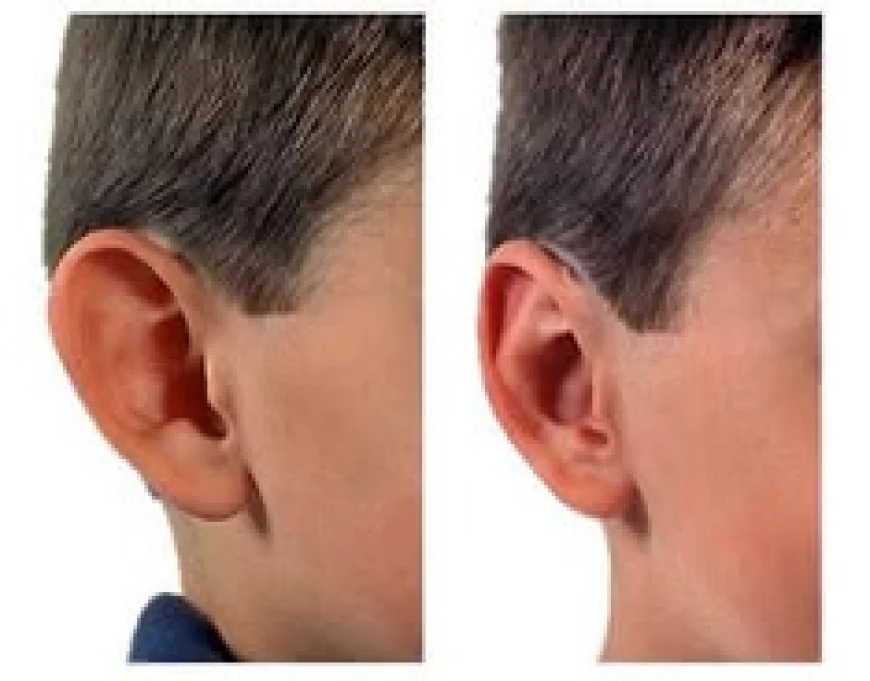 Ear Reshaping: Common Questions Answered