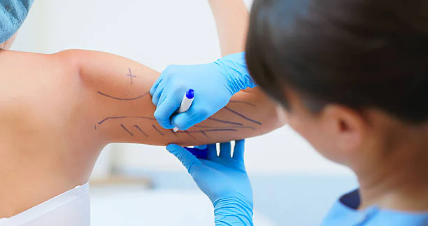 Can Laser Liposuction help contour your upper arms