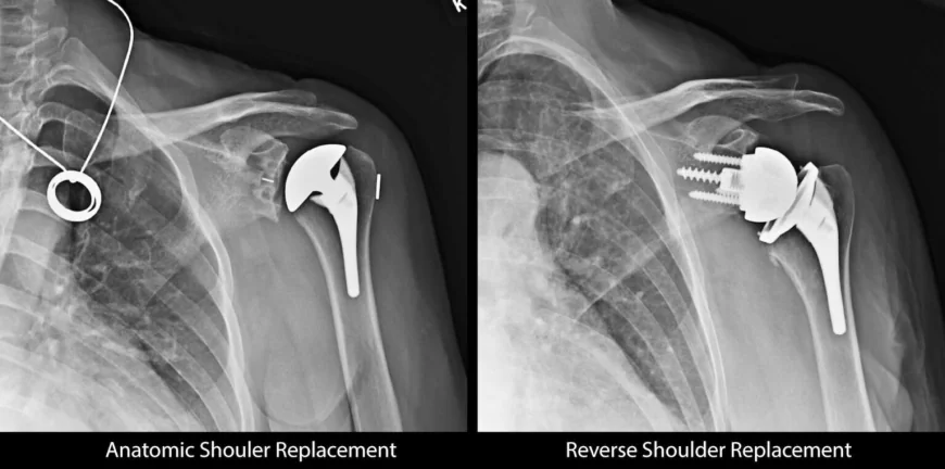 Shoulder Surgeon in Troy MI | Advanced Treatment for Shoulder Injuries