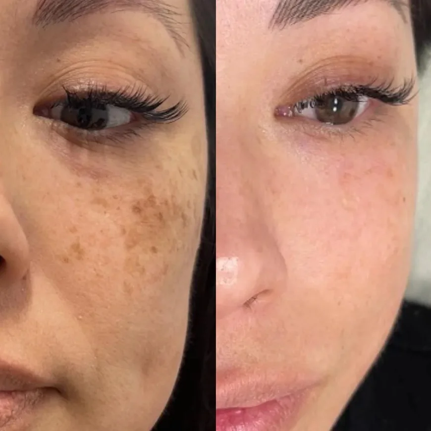 Best Skin Doctor in North East - Healthy, Glowing & Radiant Skin with Advanced Laser Treatments and Expert Dermatology Care | Essence Skin Care
