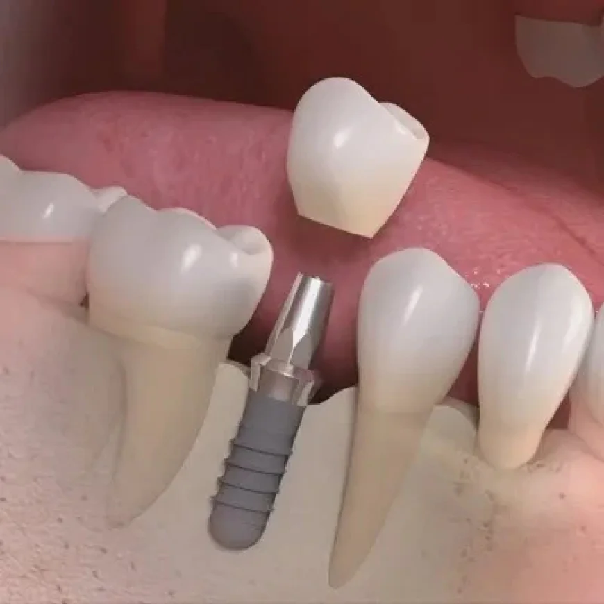Dental Implants Dubai & Abu Dhabi for a Healthier-Looking Smile | Glamorous Clinic Dubai