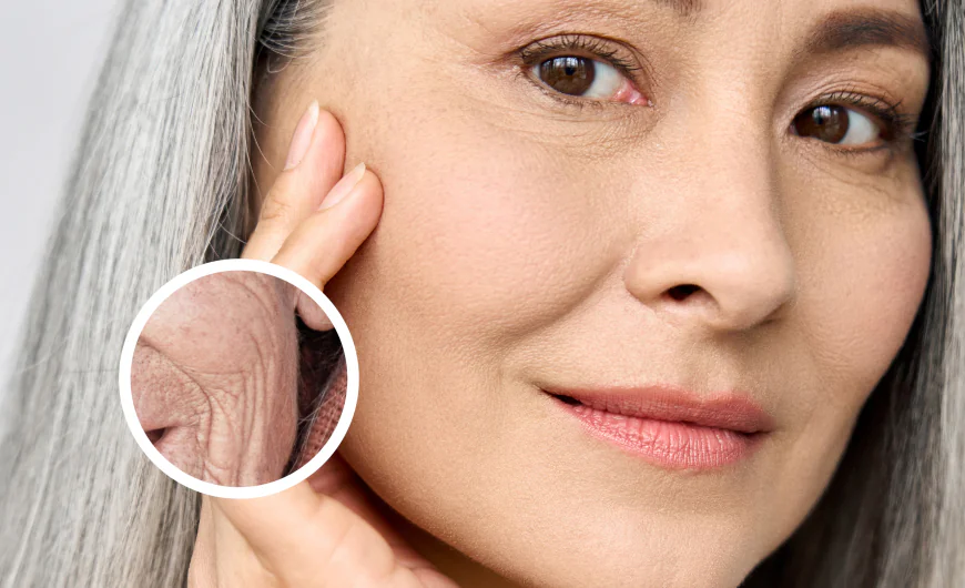 Is Fine Lines and Wrinkle Removal Suitable for All?